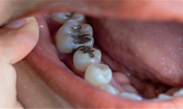 بررسی انواع مواد برای پر کردن دندان‌ها
